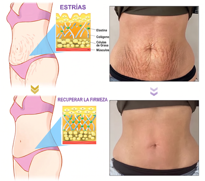 𝑹𝒆𝒄𝒐𝒎𝒆𝒏𝒅𝒂𝒅𝒐 𝙥𝙤𝙧 𝗱𝗲𝗿𝐦𝐚𝐭ó𝐥𝐨𝐠𝐨𝐬👩‍⚕️ | 🦩𝙑𝙞𝙩𝙖𝒍𝒊𝒔𝒚𝐬®𝘊𝘳𝘦𝘮𝘢 𝘔𝘢𝘴𝘢𝘫𝘦𝘢𝘥𝘰𝘳𝘢 𝘊𝘰𝘳𝘱𝘰𝘳𝘢𝘭 𝘦𝘯 𝘙𝘰𝘭𝘭-𝘖𝘯 𝘤𝘰𝘯 𝘗𝘋𝘙𝘕 𝘺 𝘔𝘶𝘭𝘵𝘪𝘱é𝘱𝘵𝘪𝘥𝘰𝘴 - 𝘈𝘯𝘵𝘪𝘦𝘯𝘷𝘦𝘫𝘦𝘤𝘪𝘮𝘪𝘦𝘯𝘵𝘰, 𝘙𝘦𝘢𝘧𝘪𝘳𝘮𝘢𝘯𝘵𝘦 𝘺 𝘌𝘧𝘦𝘤𝘵𝘰 𝘓𝘪𝘧𝘵𝘪𝘯𝘨, 𝑈𝑛𝑖𝑓𝑖𝑐𝑎 𝑒𝑙 𝑇𝑜𝑛𝑜, 𝑇𝑟𝑎𝑡𝑎𝑚𝑖𝑒𝑛𝑡𝑜 𝑝𝑎𝑟𝑎 𝐴𝑐𝑛é 𝑦 𝑀𝑎𝑛𝑐ℎ𝑎𝑠 𝑂𝑠𝑐𝑢𝑟𝑎𝑠, 𝐸𝑙𝑖𝑚𝑖𝑛𝑎𝑐𝑖ó𝑛 𝑑𝑒 𝑉𝑒𝑟𝑟𝑢𝑔𝑎𝑠 𝑦 𝐿𝑢𝑛𝑎𝑟𝑒𝑠.🐣