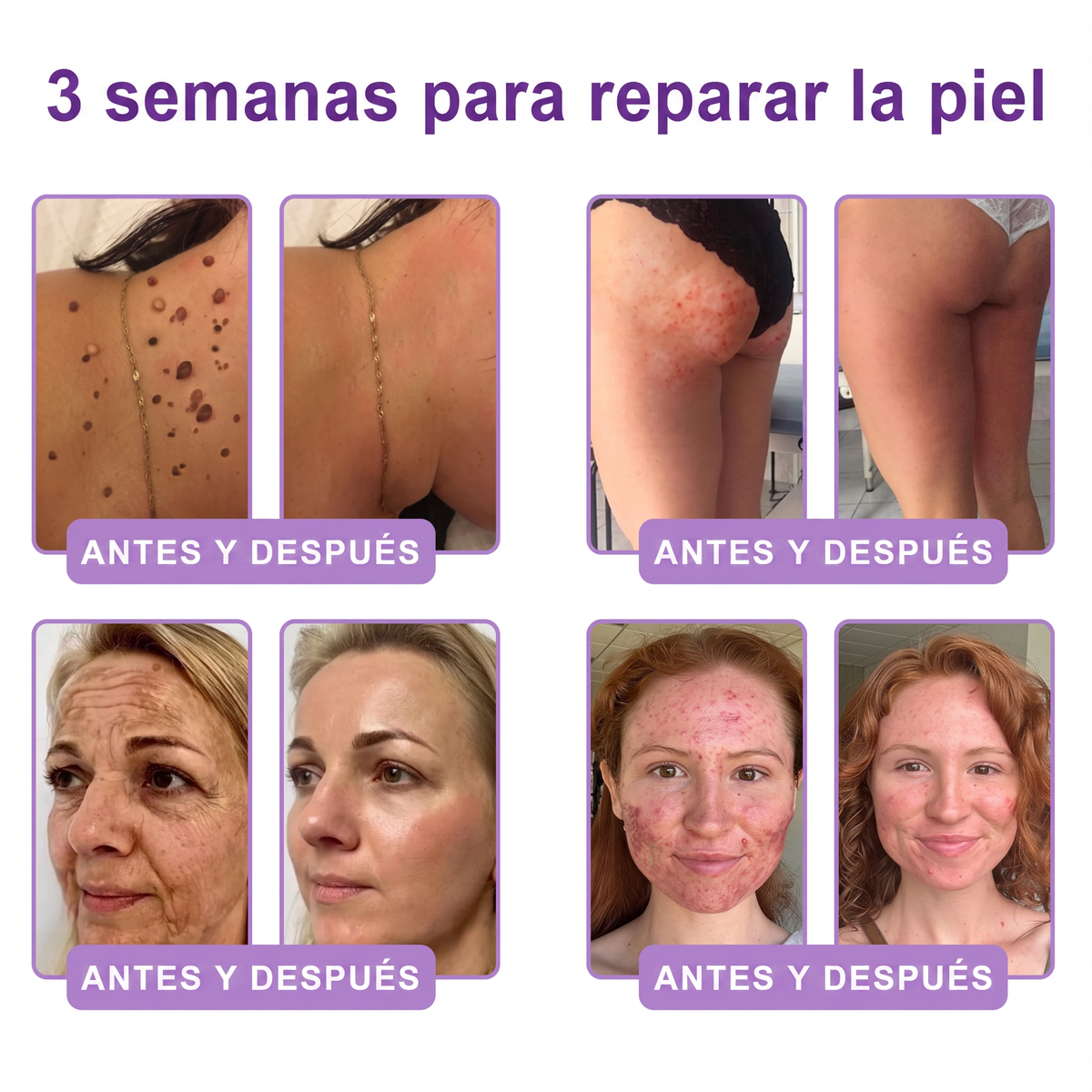 𝑹𝒆𝒄𝒐𝒎𝒆𝒏𝒅𝒂𝒅𝒐 𝙥𝙤𝙧 𝗱𝗲𝗿𝐦𝐚𝐭ó𝐥𝐨𝐠𝐨𝐬👩‍⚕️ | 🦩𝙑𝙞𝙩𝙖𝒍𝒊𝒔𝒚𝐬®𝘊𝘳𝘦𝘮𝘢 𝘔𝘢𝘴𝘢𝘫𝘦𝘢𝘥𝘰𝘳𝘢 𝘊𝘰𝘳𝘱𝘰𝘳𝘢𝘭 𝘦𝘯 𝘙𝘰𝘭𝘭-𝘖𝘯 𝘤𝘰𝘯 𝘗𝘋𝘙𝘕 𝘺 𝘔𝘶𝘭𝘵𝘪𝘱é𝘱𝘵𝘪𝘥𝘰𝘴 - 𝘈𝘯𝘵𝘪𝘦𝘯𝘷𝘦𝘫𝘦𝘤𝘪𝘮𝘪𝘦𝘯𝘵𝘰, 𝘙𝘦𝘢𝘧𝘪𝘳𝘮𝘢𝘯𝘵𝘦 𝘺 𝘌𝘧𝘦𝘤𝘵𝘰 𝘓𝘪𝘧𝘵𝘪𝘯𝘨, 𝑈𝑛𝑖𝑓𝑖𝑐𝑎 𝑒𝑙 𝑇𝑜𝑛𝑜, 𝑇𝑟𝑎𝑡𝑎𝑚𝑖𝑒𝑛𝑡𝑜 𝑝𝑎𝑟𝑎 𝐴𝑐𝑛é 𝑦 𝑀𝑎𝑛𝑐ℎ𝑎𝑠 𝑂𝑠𝑐𝑢𝑟𝑎𝑠, 𝐸𝑙𝑖𝑚𝑖𝑛𝑎𝑐𝑖ó𝑛 𝑑𝑒 𝑉𝑒𝑟𝑟𝑢𝑔𝑎𝑠 𝑦 𝐿𝑢𝑛𝑎𝑟𝑒𝑠.🐣