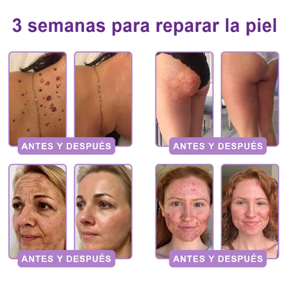 𝑹𝒆𝒄𝒐𝒎𝒆𝒏𝒅𝒂𝒅𝒐 𝙥𝙤𝙧 𝗱𝗲𝗿𝐦𝐚𝐭ó𝐥𝐨𝐠𝐨𝐬👩‍⚕️ | 🦩𝙑𝙞𝙩𝙖𝒍𝒊𝒔𝒚𝐬®𝘊𝘳𝘦𝘮𝘢 𝘔𝘢𝘴𝘢𝘫𝘦𝘢𝘥𝘰𝘳𝘢 𝘊𝘰𝘳𝘱𝘰𝘳𝘢𝘭 𝘦𝘯 𝘙𝘰𝘭𝘭-𝘖𝘯 𝘤𝘰𝘯 𝘗𝘋𝘙𝘕 𝘺 𝘔𝘶𝘭𝘵𝘪𝘱é𝘱𝘵𝘪𝘥𝘰𝘴 - 𝘈𝘯𝘵𝘪𝘦𝘯𝘷𝘦𝘫𝘦𝘤𝘪𝘮𝘪𝘦𝘯𝘵𝘰, 𝘙𝘦𝘢𝘧𝘪𝘳𝘮𝘢𝘯𝘵𝘦 𝘺 𝘌𝘧𝘦𝘤𝘵𝘰 𝘓𝘪𝘧𝘵𝘪𝘯𝘨, 𝑈𝑛𝑖𝑓𝑖𝑐𝑎 𝑒𝑙 𝑇𝑜𝑛𝑜, 𝑇𝑟𝑎𝑡𝑎𝑚𝑖𝑒𝑛𝑡𝑜 𝑝𝑎𝑟𝑎 𝐴𝑐𝑛é 𝑦 𝑀𝑎𝑛𝑐ℎ𝑎𝑠 𝑂𝑠𝑐𝑢𝑟𝑎𝑠, 𝐸𝑙𝑖𝑚𝑖𝑛𝑎𝑐𝑖ó𝑛 𝑑𝑒 𝑉𝑒𝑟𝑟𝑢𝑔𝑎𝑠 𝑦 𝐿𝑢𝑛𝑎𝑟𝑒𝑠.🐣