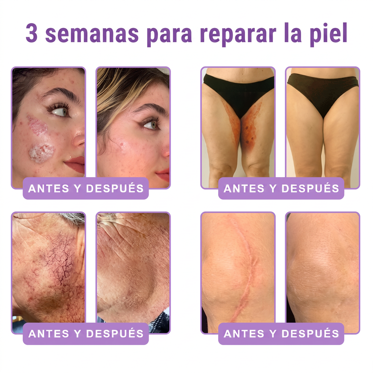 𝑹𝒆𝒄𝒐𝒎𝒆𝒏𝒅𝒂𝒅𝒐 𝙥𝙤𝙧 𝗱𝗲𝗿𝐦𝐚𝐭ó𝐥𝐨𝐠𝐨𝐬👩‍⚕️ | 🦩𝙑𝙞𝙩𝙖𝒍𝒊𝒔𝒚𝐬®𝘊𝘳𝘦𝘮𝘢 𝘔𝘢𝘴𝘢𝘫𝘦𝘢𝘥𝘰𝘳𝘢 𝘊𝘰𝘳𝘱𝘰𝘳𝘢𝘭 𝘦𝘯 𝘙𝘰𝘭𝘭-𝘖𝘯 𝘤𝘰𝘯 𝘗𝘋𝘙𝘕 𝘺 𝘔𝘶𝘭𝘵𝘪𝘱é𝘱𝘵𝘪𝘥𝘰𝘴 - 𝘈𝘯𝘵𝘪𝘦𝘯𝘷𝘦𝘫𝘦𝘤𝘪𝘮𝘪𝘦𝘯𝘵𝘰, 𝘙𝘦𝘢𝘧𝘪𝘳𝘮𝘢𝘯𝘵𝘦 𝘺 𝘌𝘧𝘦𝘤𝘵𝘰 𝘓𝘪𝘧𝘵𝘪𝘯𝘨, 𝑈𝑛𝑖𝑓𝑖𝑐𝑎 𝑒𝑙 𝑇𝑜𝑛𝑜, 𝑇𝑟𝑎𝑡𝑎𝑚𝑖𝑒𝑛𝑡𝑜 𝑝𝑎𝑟𝑎 𝐴𝑐𝑛é 𝑦 𝑀𝑎𝑛𝑐ℎ𝑎𝑠 𝑂𝑠𝑐𝑢𝑟𝑎𝑠, 𝐸𝑙𝑖𝑚𝑖𝑛𝑎𝑐𝑖ó𝑛 𝑑𝑒 𝑉𝑒𝑟𝑟𝑢𝑔𝑎𝑠 𝑦 𝐿𝑢𝑛𝑎𝑟𝑒𝑠.🐣