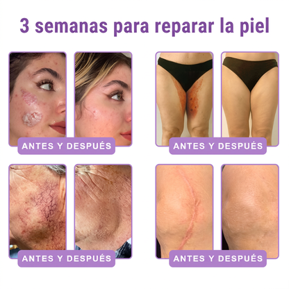 𝑹𝒆𝒄𝒐𝒎𝒆𝒏𝒅𝒂𝒅𝒐 𝙥𝙤𝙧 𝗱𝗲𝗿𝐦𝐚𝐭ó𝐥𝐨𝐠𝐨𝐬👩‍⚕️ | 🦩𝙑𝙞𝙩𝙖𝒍𝒊𝒔𝒚𝐬®𝘊𝘳𝘦𝘮𝘢 𝘔𝘢𝘴𝘢𝘫𝘦𝘢𝘥𝘰𝘳𝘢 𝘊𝘰𝘳𝘱𝘰𝘳𝘢𝘭 𝘦𝘯 𝘙𝘰𝘭𝘭-𝘖𝘯 𝘤𝘰𝘯 𝘗𝘋𝘙𝘕 𝘺 𝘔𝘶𝘭𝘵𝘪𝘱é𝘱𝘵𝘪𝘥𝘰𝘴 - 𝘈𝘯𝘵𝘪𝘦𝘯𝘷𝘦𝘫𝘦𝘤𝘪𝘮𝘪𝘦𝘯𝘵𝘰, 𝘙𝘦𝘢𝘧𝘪𝘳𝘮𝘢𝘯𝘵𝘦 𝘺 𝘌𝘧𝘦𝘤𝘵𝘰 𝘓𝘪𝘧𝘵𝘪𝘯𝘨, 𝑈𝑛𝑖𝑓𝑖𝑐𝑎 𝑒𝑙 𝑇𝑜𝑛𝑜, 𝑇𝑟𝑎𝑡𝑎𝑚𝑖𝑒𝑛𝑡𝑜 𝑝𝑎𝑟𝑎 𝐴𝑐𝑛é 𝑦 𝑀𝑎𝑛𝑐ℎ𝑎𝑠 𝑂𝑠𝑐𝑢𝑟𝑎𝑠, 𝐸𝑙𝑖𝑚𝑖𝑛𝑎𝑐𝑖ó𝑛 𝑑𝑒 𝑉𝑒𝑟𝑟𝑢𝑔𝑎𝑠 𝑦 𝐿𝑢𝑛𝑎𝑟𝑒𝑠.🐣